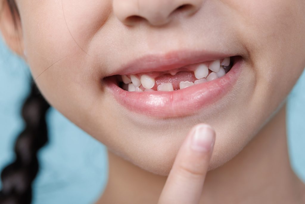 Asian,Child,Girl,Missing,Front,Loose,Tooth,Pointing,,Dentistry,And