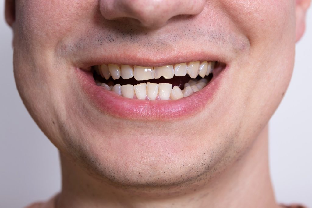 Close,Up,Of,Male,Smile,With,Chipped,,Damaged,Tooth.,Concept