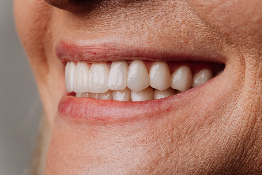 Side,View,Of,Mature,Woman,Smile,With,White,Porcelain,Veneers