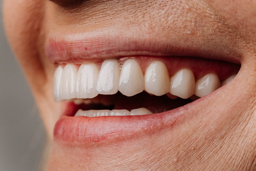 Closeup,Of,Bright,White,Veneers,On,Mature,Woman,Smile,,Natural
