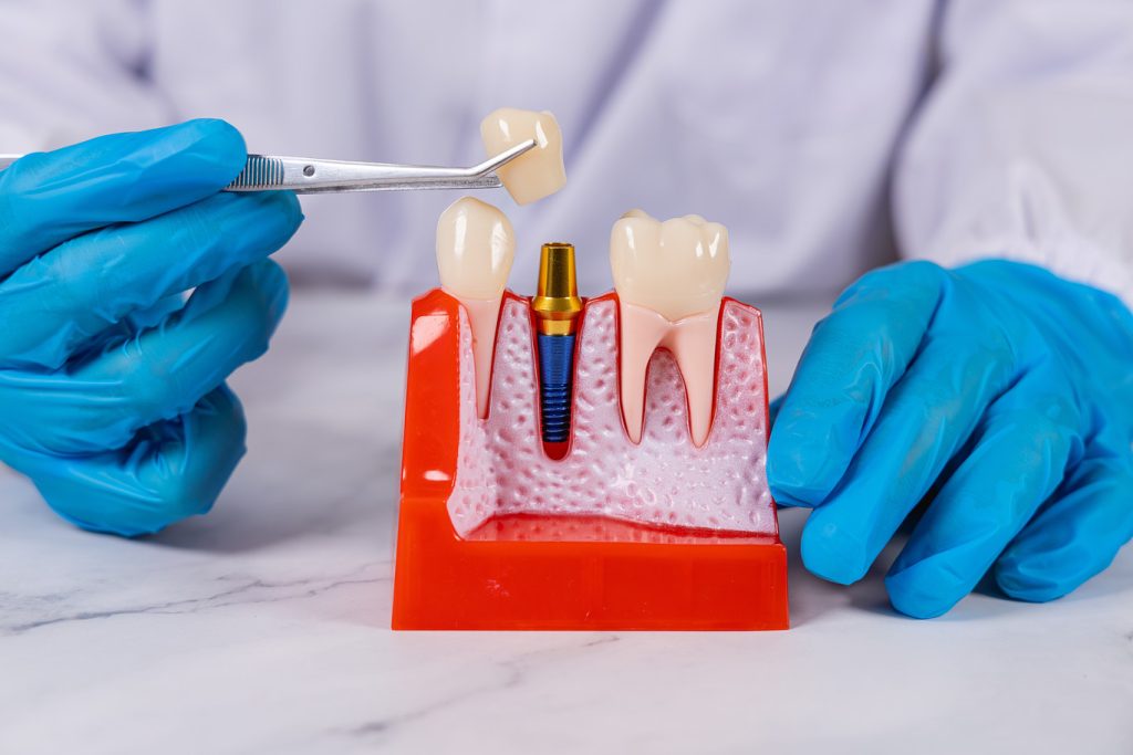 A,Dentist,Is,Removing,A,False,Crown,Tooth,From,A