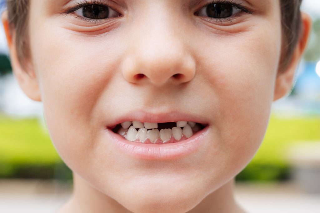 Happy,Child,With,A,Missing,Milk,Tooth,Smiling,At,The