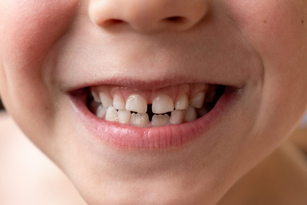 Child's,Smile.,Child's,Teeth.,Baby,White,Teeth,Of,A,White-skinned